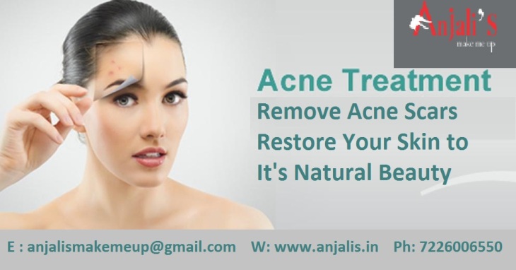 Acne Pro Treatment - Anjalis Salon